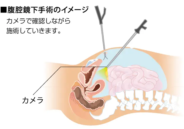 当院の子宮筋腫手術の特色