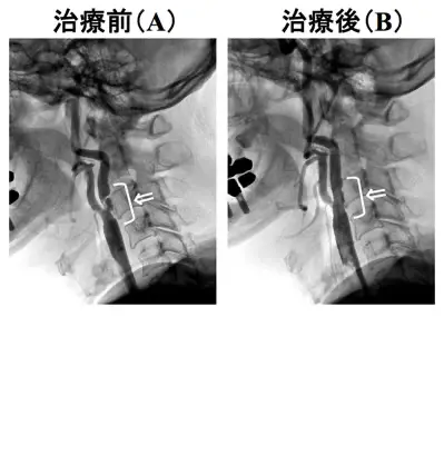 頸動脈ステント留置術の難関症例①