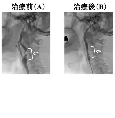 頸動脈ステント留置術の難関症例②