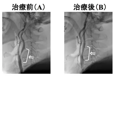 頸動脈ステント留置術の難関症例④