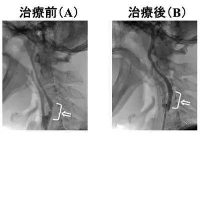 頸動脈ステント留置術の難関症例⑤