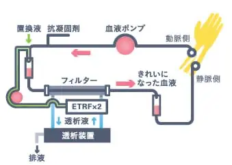 オンラインHDF（血液透析ろ過療法）